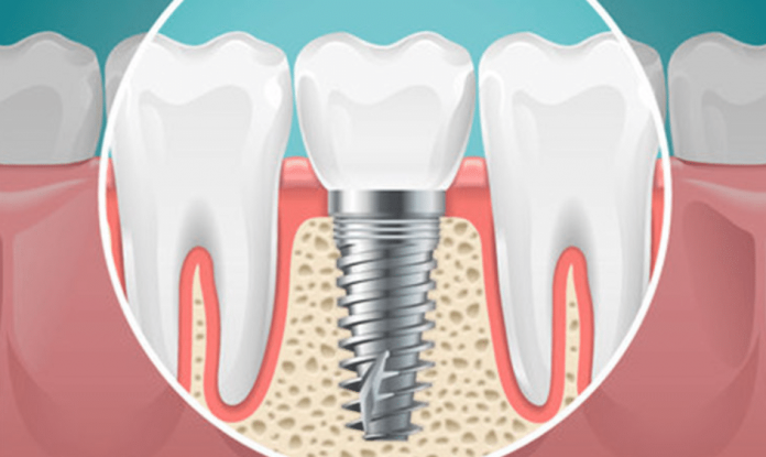 implant-dentar